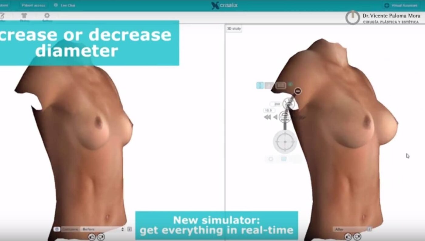 Aumento de Pecho | crisalix simulador-3d