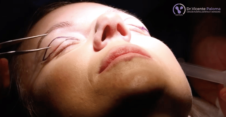 Dr. Vicente Paloma | Blefaroplastia Video