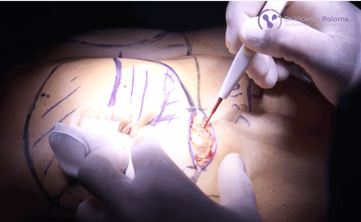 Dr.-Vicente-Paloma-Bisturí-eléctrico-en-aumento-de-pecho