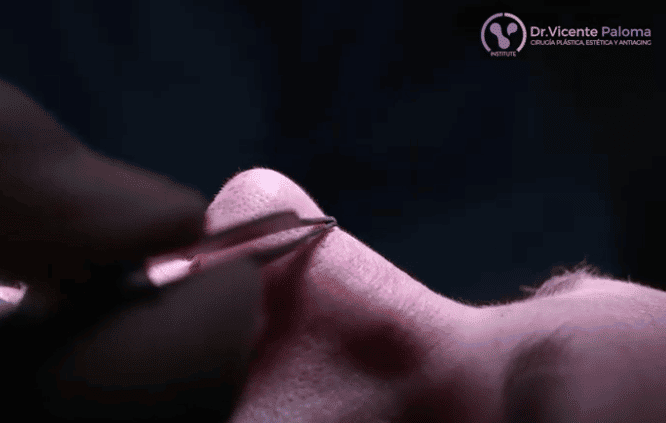 Rinoplastia-abierta-Dr.-Vicente-Paloma