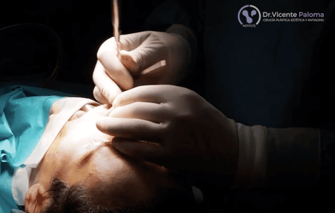 Rinoplastia-abierta-video-Dr.-Vicente-Paloma