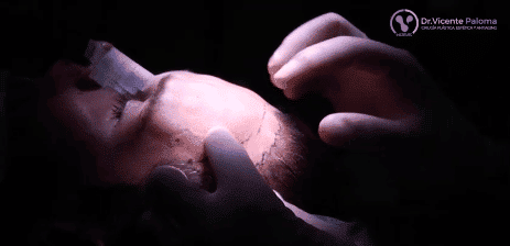 Cirugía feminización facial con reducción de frente