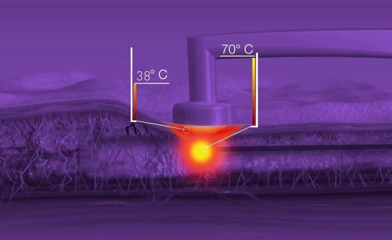 BodyTite_Remodelación corporal cánulas