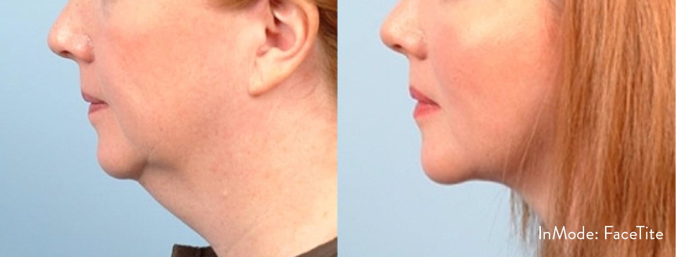 FaceTite | Antes y Despues