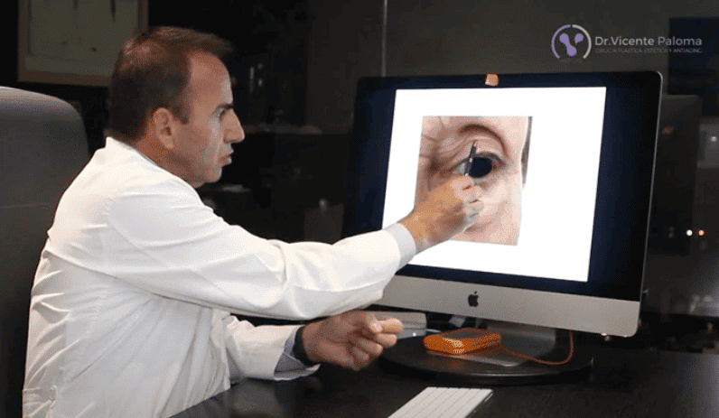 Blefaroplastia superior correccion parpados caidos