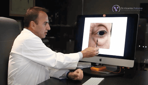 Dr. Vicente Paloma | Blefaroplastia superior