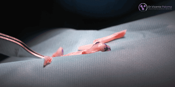 Reducción tabique nasal | Rinoplastia abierta | Dr. Vicente Paloma