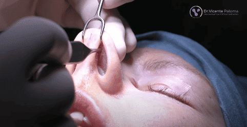 Rinoplastia Abierta Abordaje | Dr. Vicente Paloma
