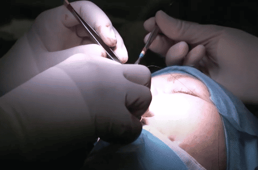 Rinoplastia abierta | Como dar forma a la nariz | Dr Paloma