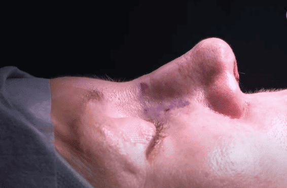 Rinoplastia abierta | Como dar forma a la nariz | Dr Paloma