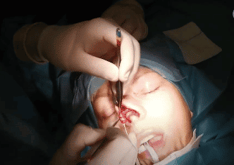 Rinoplastia abierta cirugía | Dr. Vicente Paloma