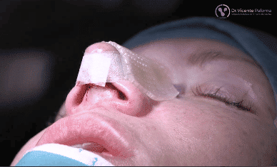 Rinoplastia abierta y vendaje | Dr. Vicente Paloma