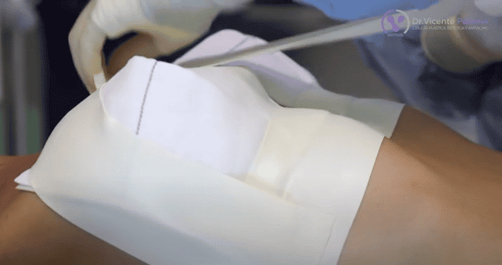 aumento de pecho relaciones sexuales | Dr. Vicente Paloma