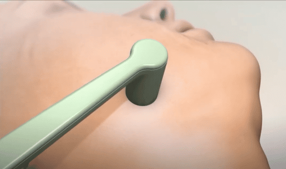 liposuccion sin cirugia