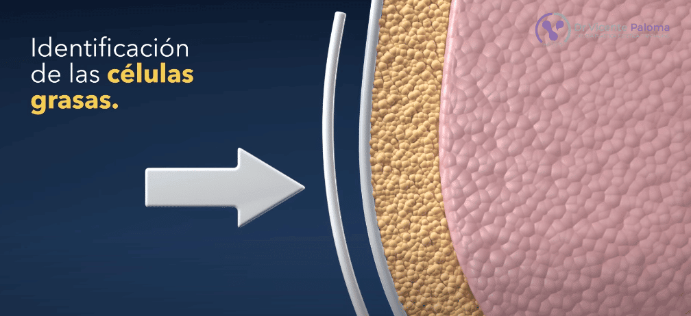 CoolSculpting | Eliminación grasa localizada