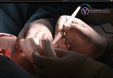 Reducción mamaria postoperatorio | Dr. Vicente Paloma