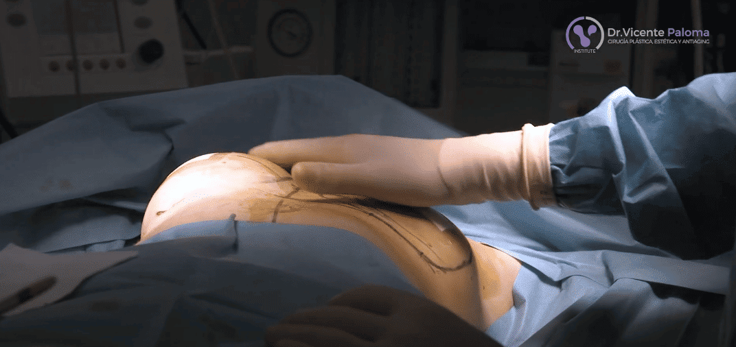 corrección de asimetría mamaria