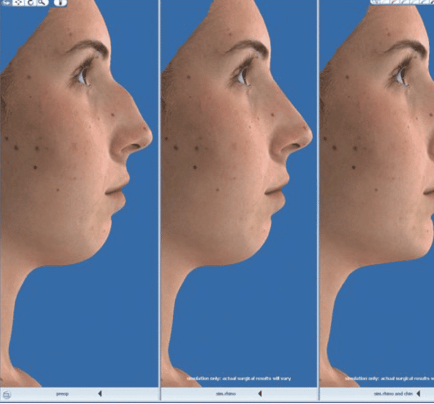 Rinoplastia-Simulación-Dr.-Vicente-Paloma