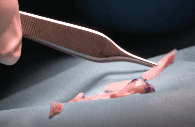 Rinoplastia: la técnica quirúrgica