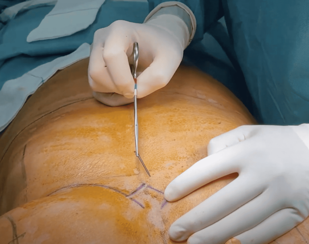 Reducción mamaria y abdominoplastia invertida