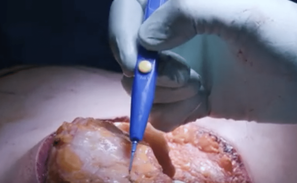 cirugía de reducción y elevación de mamas