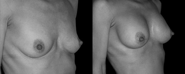 Aumento de mamas. Plano submuscular.