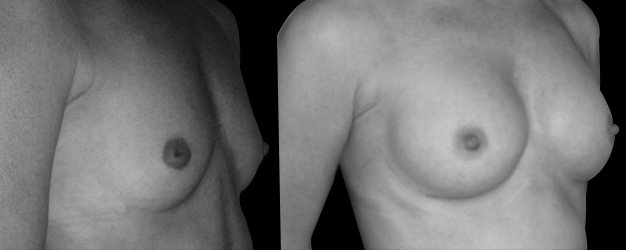 Aumento de pecho. Plano debajo del músculo.