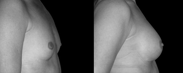 Aumento de pecho. Cicatriz surco submamario.