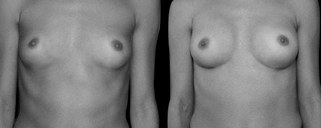 Aumento de pecho antes y después. Prótesis redonda: 200 grs.