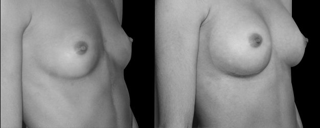 Aumento de pecho antes y después. Plano debajo del músculo.