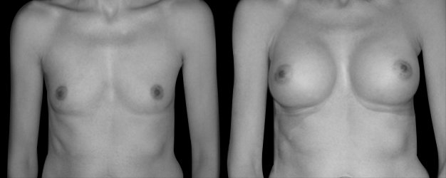 Aumento de pecho natural. Prótesis forma de gota de agua: 295 grs.