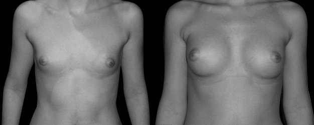 Aumento de senos. Prótesis anatómicas: 245 grs.