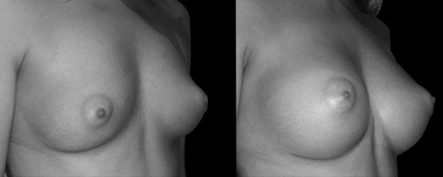 Mamoplastia de aumento. Plano subfascial.