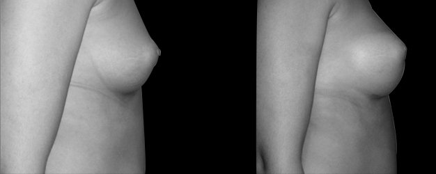 Mamoplastia de aumento. Técnica Inframamaria.