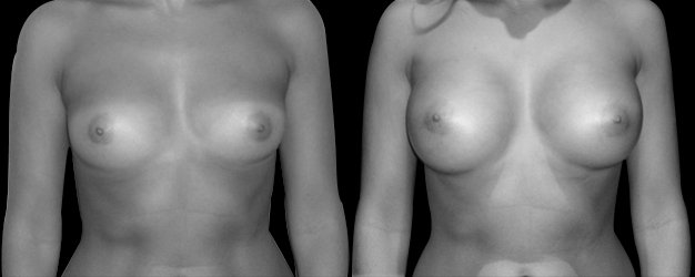 Operación aumento de pecho. Implante anatómico: 285 grs.