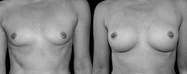 Operación de pecho. Implantes forma gota de agua: 220 grs.