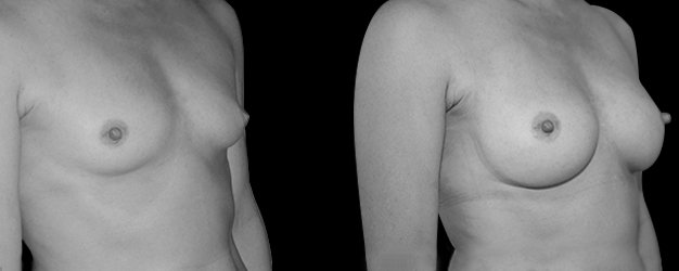 Operación de pecho. Plano debajo del músculo.