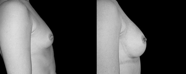 Operación de pecho. Vía submamamaria.