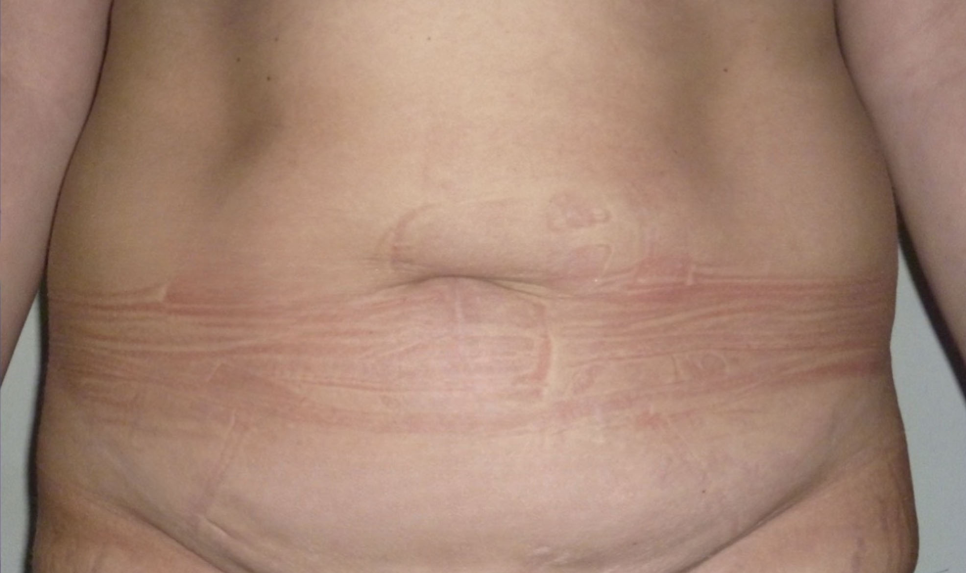 Abdominoplastia antes y después.