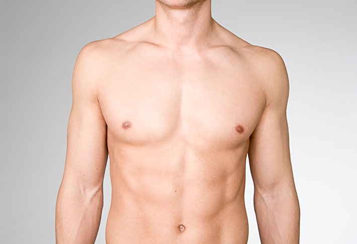Resultado mini abdominoplastia.