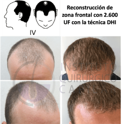 Técnica FUE frontal antes y después