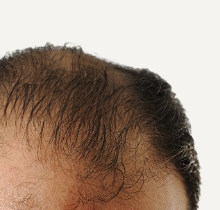 Tratamientos capilares hombres en Barcelona