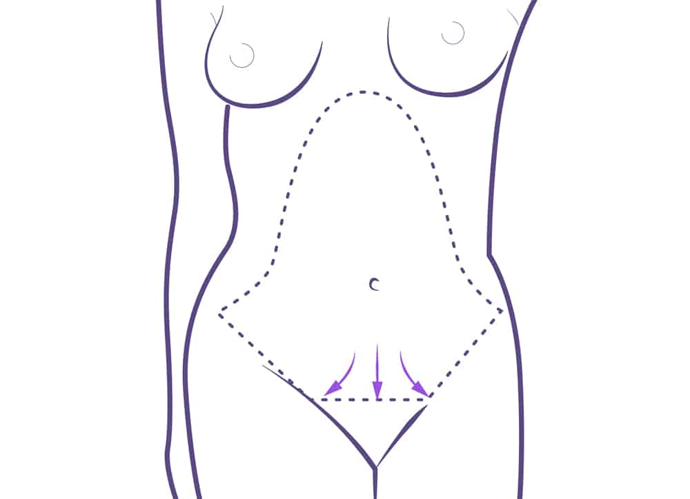 Abdominoplastia cicatriz.