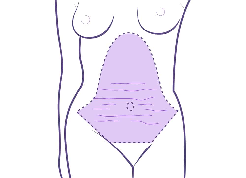 Abdominoplastia operación.