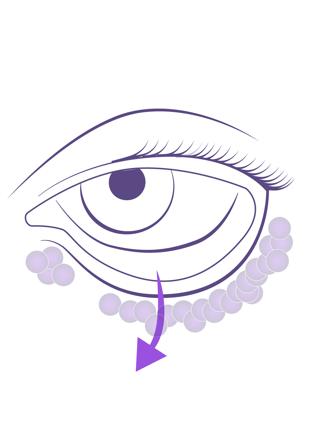 Blefaroplastia transconjuntival en jóvenes