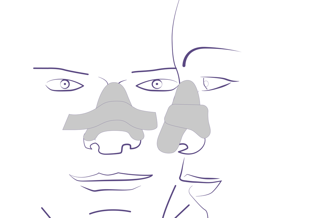 Férula postoperatorio cirugía nariz.