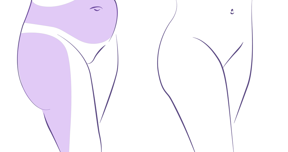 Liposucción caderas antes y después.