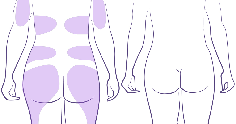 Liposucción gluteos antes y después.