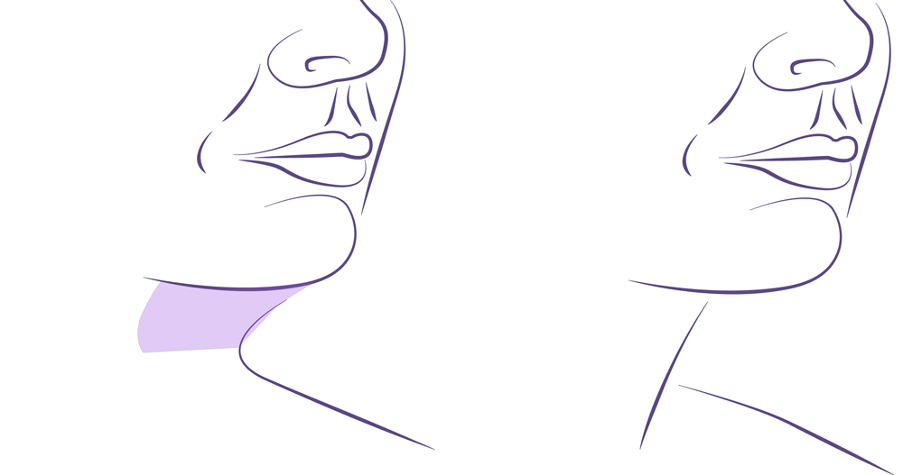 Liposucción papada antes y después.