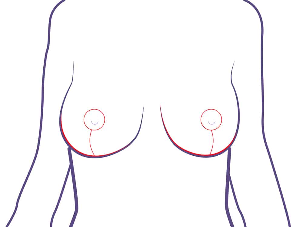 Resultado final y cicatrices tras reducción de pecho